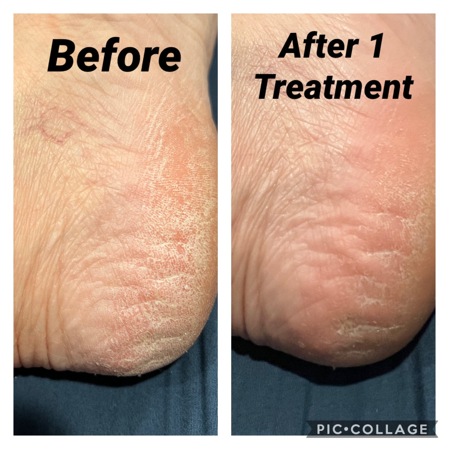 Heel & Elbow Softening Cream